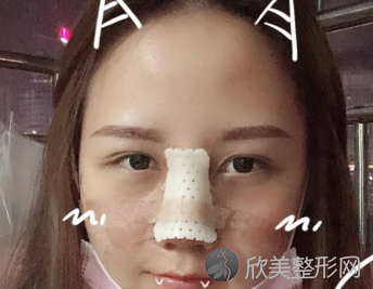 上海九院隆鼻术后三个月真实反馈-2021价格表更新