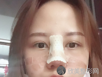 上海九院隆鼻术后三个月真实反馈-2021价格表更新