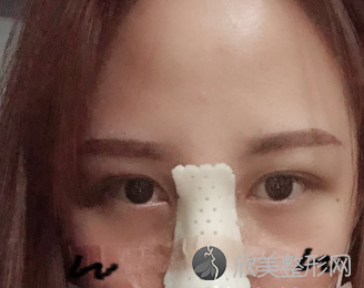 上海九院隆鼻术后三个月真实反馈-2021价格表更新