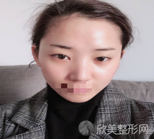 上海哪个医生做眼修复较好-柴云怎么样-附2021价格表