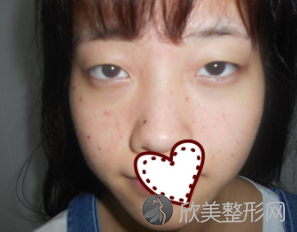 西安哪个医生双眼皮较好-孙峰怎么样-附西京2021价格表