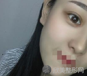 成都双眼皮游晓波和刘全哪个较好-附2021年价格表