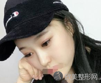 成都双眼皮游晓波和刘全哪个较好-附2021年价格表