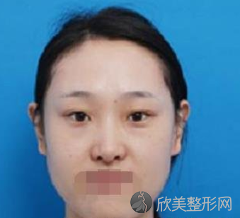 成都双眼皮游晓波和刘全哪个较好-附2021年价格表