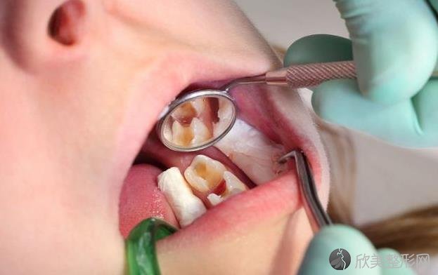 什么是龋齿？龋齿分为4种类型，较好种比较常见！