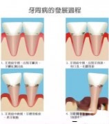 牙周炎是口腔健康的头号杀手！