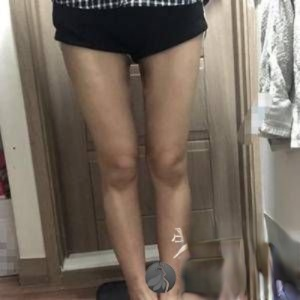 天津华中医疗整形医院是正规的么？附案例-全新价格表