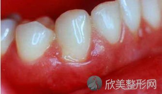 牙周炎的危害及预防是什么？
