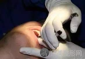 下颌阻生齿拔除术流程