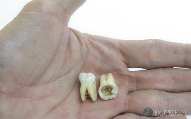 龋齿分为不同种类，出现这种情况，就是轻度龋齿的范围了！