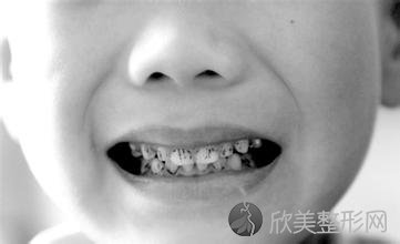 儿童气质与龋齿的相关性！