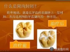 做窝沟封闭就永远不会得龋齿吗？