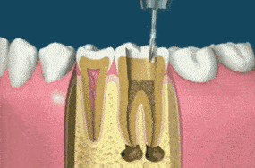 为什么说“补牙不做冠，疗效少一半”，牙冠到底有多重要？