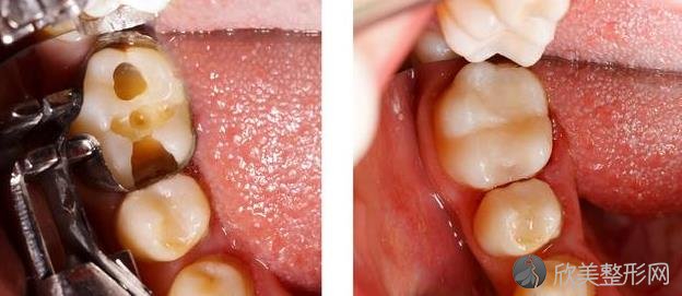 补牙到底补的是什么？为什么还要将牙洞钻大？带你了解补牙全过程！