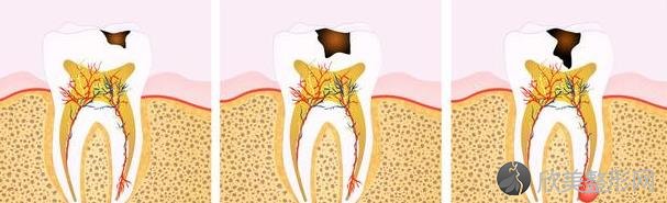 补牙到底补的是什么？为什么还要将牙洞钻大？带你了解补牙全过程！