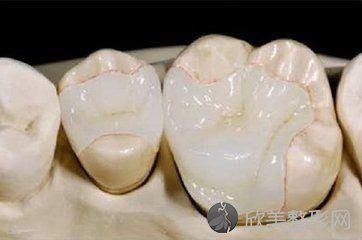 补牙的材料该怎么选？