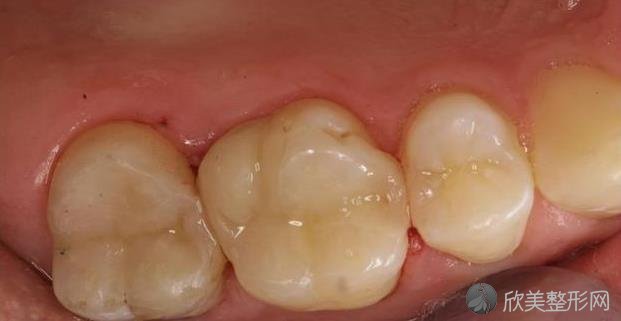 你知道牙医补牙的全过程吗？
