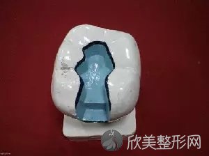嵌体补牙那些事!