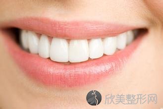 既简单又快捷的牙齿美白修复技术一牙齿贴面修复！