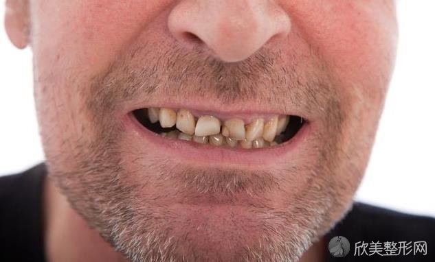 牙齿发黄是怎么回事？
