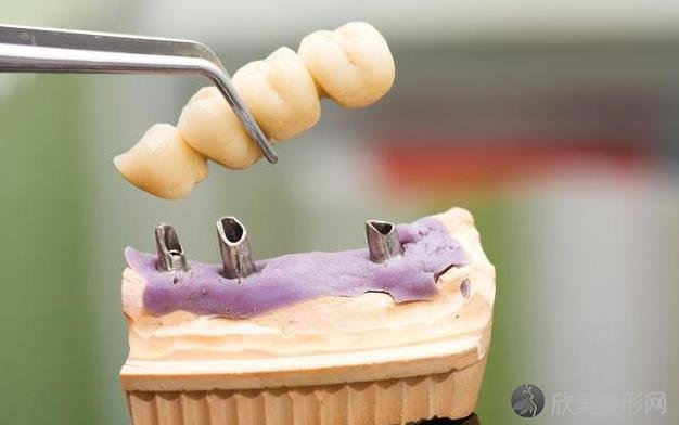 选择正确的假牙，效果可能比一颗真牙更好！