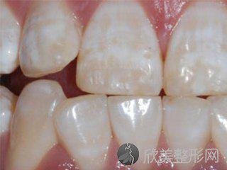 氟斑牙是如何形成的？