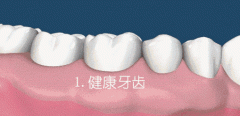 牙周炎，掉牙，牙齿不齐三个高发口腔问题！