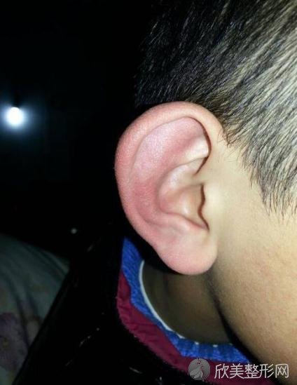 外耳再造多少钱？外耳再造手术有危险吗
