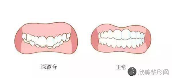 你的牙齿是否属于这几种情况？