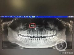 关于‘异位牙’你了解多少？