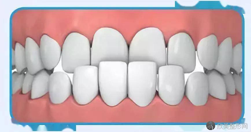 父母注意啦！孩子12岁前必须处理的12种牙颌畸形