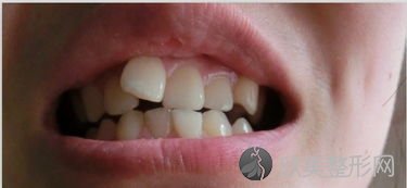 孩子牙齿参差不齐，可能是这些原因导致的，家长的干预很重要！
