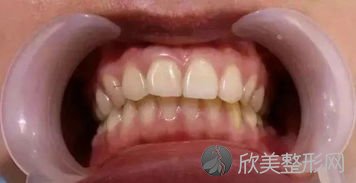 牙齿黄了有哪些方法可以变白？