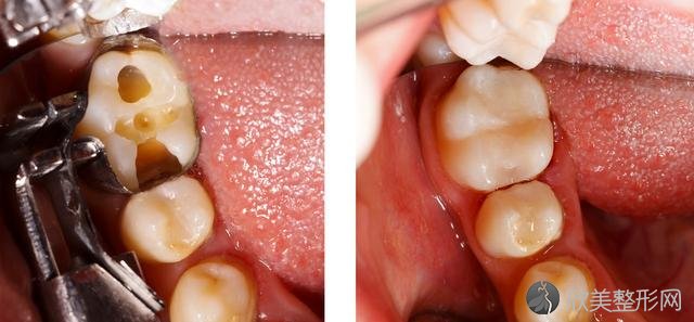牙齿碎裂怎么办？别慌，这4种方式来帮你修复！