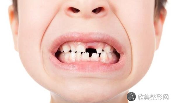 全口牙齿缺失会影响消化功能？别慌，这3种方法可以帮助修复！