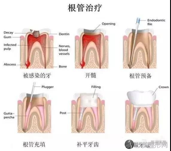 根管治疗为什么那么贵？