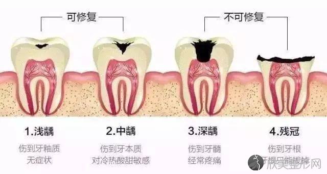 做完根管治疗后，为什么要做冠？