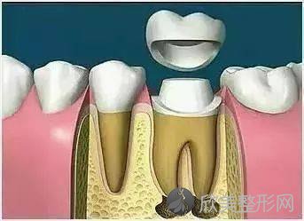 做完根管治疗后，为什么要做冠？