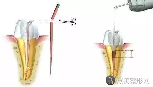做完根管治疗后，为什么要做冠？