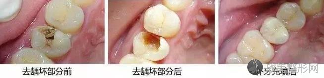牙齿龋坏到什么程度，才需要做根管治疗？