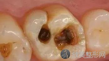 牙齿龋坏到什么程度，才需要做根管治疗？