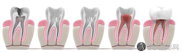 牙齿又痛了？根管治疗的四个步骤！