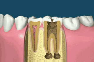 牙齿做根管治疗到底有多恐怖？