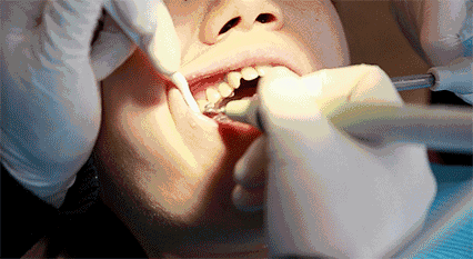 医生建议你根管治疗，而不是补牙，为什么？