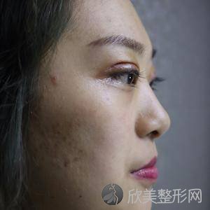 八大处周传德打水光针怎么样?双眼皮地址-价格在线查询