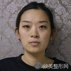 八大处周传德打水光针怎么样?双眼皮地址-价格在线查询