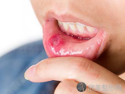 口腔溃疡有什么症状表现？