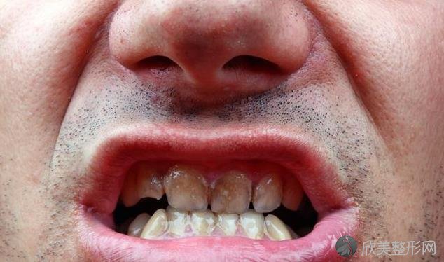 牙周炎是小病？看清这几个后果，发现牙周病要及早治！