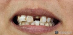 牙磕断了一半怎么办？牙缺损要如何修复？