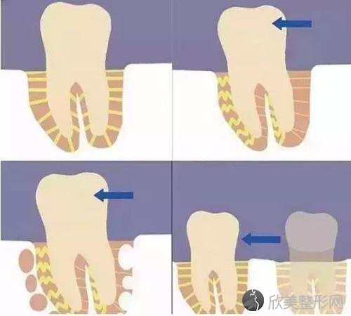 牙齿缺失了，健康在扣分，而且这两招修复方法不一定靠谱！